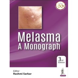 Melasma: A Monograph