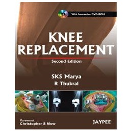 Knee Replacement