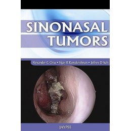 Sinonasal Tumors