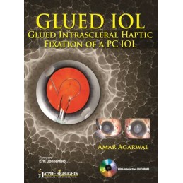 GLUED IOL: Glued Intrascleral Haptic Fixation of a PC IOL