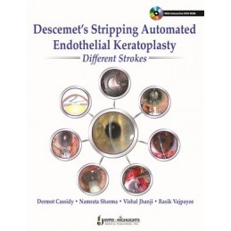 Descemet's Stripping Automated Endothelial Keratoplasty: Different Strokes