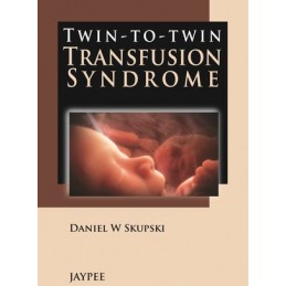 Twin-to-Twin Transfusion...