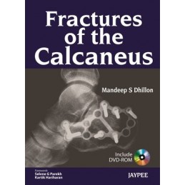 Fractures of the Calcaneus