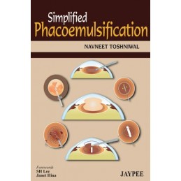 Simplified Phacoemulsification