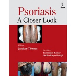 Psoriasis: A Closer Look