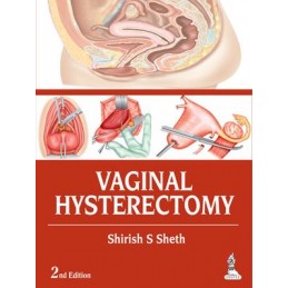 Vaginal Hysterectomy