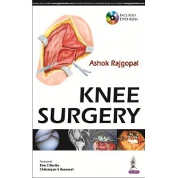 Knee Surgery