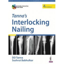 Tanna's Interlocking Nailing