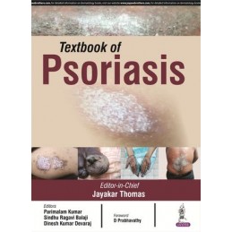 Textbook of Psoriasis