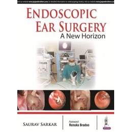 Endoscopic Ear Surgery: A...