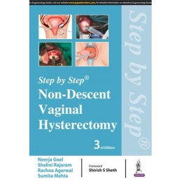 Step by Step: Non-Descent Vaginal Hysterectomy