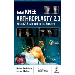 Total Knee Arthroplasty...