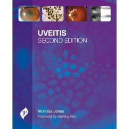 Uveitis