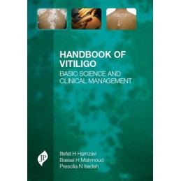Handbook of Vitiligo: Basic Science and Clinical Management