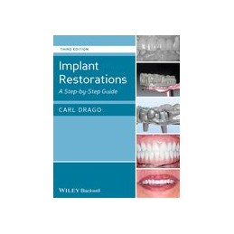 Implant Restorations: A...