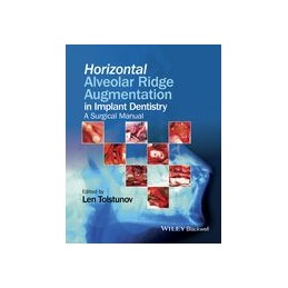 Horizontal Alveolar Ridge Augmentation in Implant Dentistry: A Surgical Manual