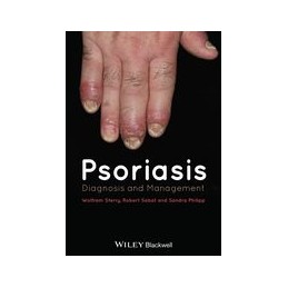 Psoriasis: Diagnosis and...