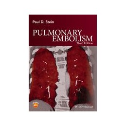 Pulmonary Embolism