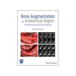 Bone Augmentation by...