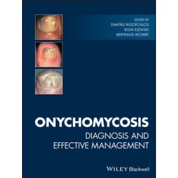 Onychomycosis: Diagnosis and Effective Management