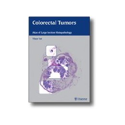 Colorectal Tumors
