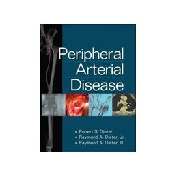 Peripheral Arterial Disease