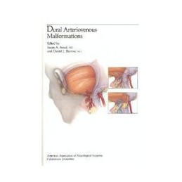 Dural Arteriovenous Malformation