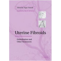 Uterine Fibroids:...