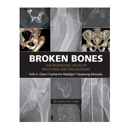 Broken Bones: The...