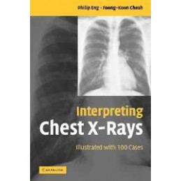 Interpreting Chest X-Rays:...