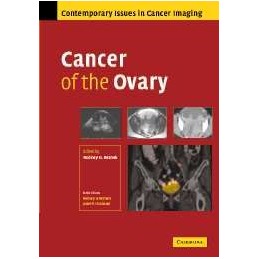 Cancer of the Ovary