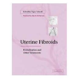 Uterine Fibroids:...