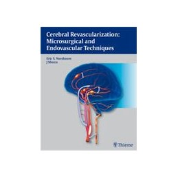 Cerebral Revascularization: Microsurgical and Endovascular Techniques