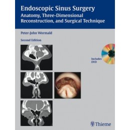 Endoscopic Sinus Surgery: Anatomy, Three-Dimensional Reconstruction, and Surgical Technique