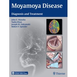 Moyamoya Disease: Diagnosis...