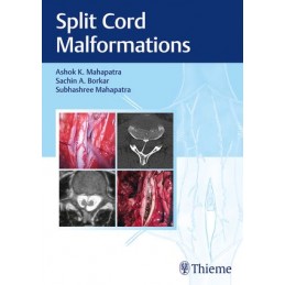 Split Cord Malformations