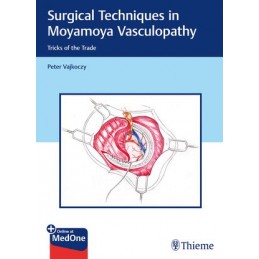 Surgical Techniques in Moyamoya Vasculopathy: Tricks of the Trade