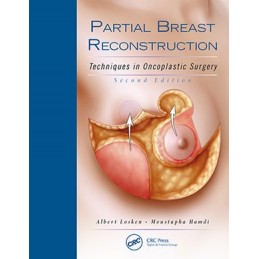 Partial Breast Reconstruction: Techniques in Oncoplastic Surgery
