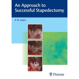 An Approach to Successful Stapedectomy