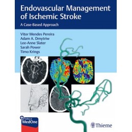 Endovascular Management of Ischemic Stroke: A Case-Based Approach
