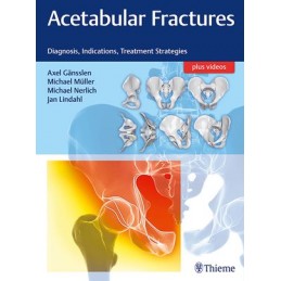 Acetabular Fractures: Diagnosis, Indications, Treatment Strategies
