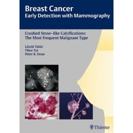 Breast Cancer: Early Detection with Mammography: Crushed Stone-like Calcifications: The Most Frequent Malignant Type