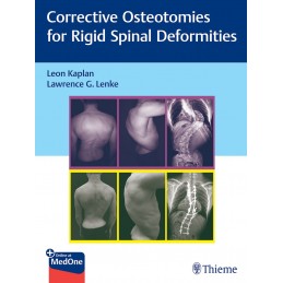 Corrective Osteotomies for Rigid Spinal Deformities