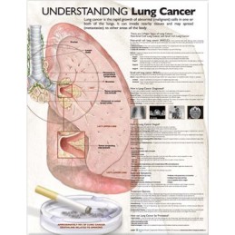 Understanding Lung Cancer Anatomical Chart