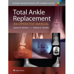 Total Ankle Replacement:...