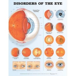 Disorders of the Eye...