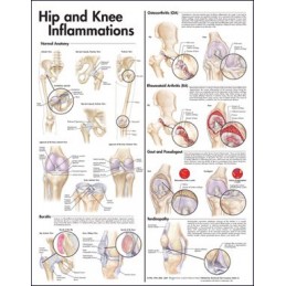 Hip and Knee Inflammations...