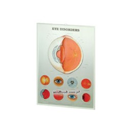 Eye Disorders: 3D Lenticular Chart
