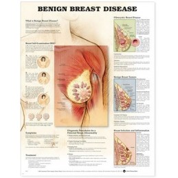 Benign Breast Disease Anatomical Chart