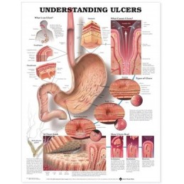Understanding Ulcers...
